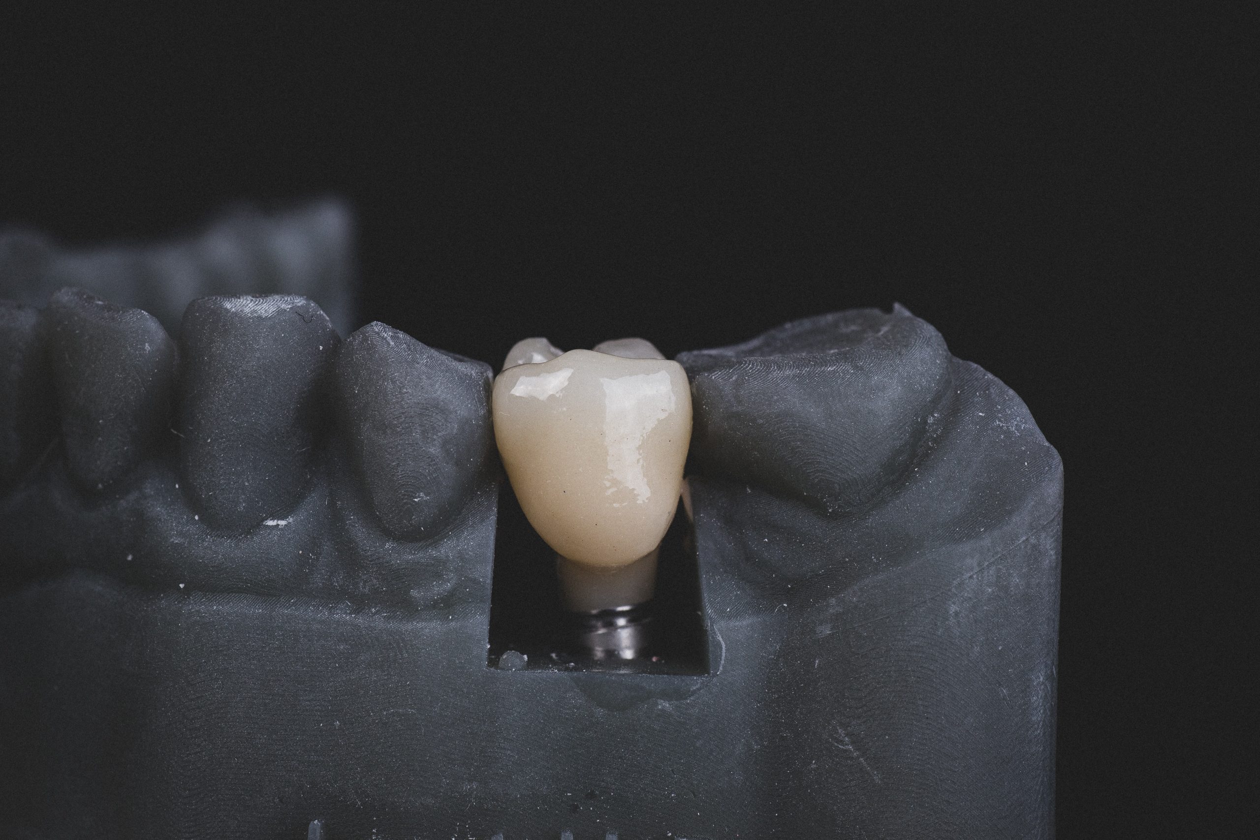 The Complete Guide to Dental Implants: Why You Should Consider Implants in Richland, WA
