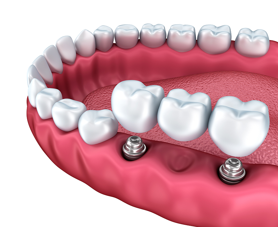 The Ultimate Guide to Dental Implants in Richmond, WA: Restoring Your Smile with Confidence