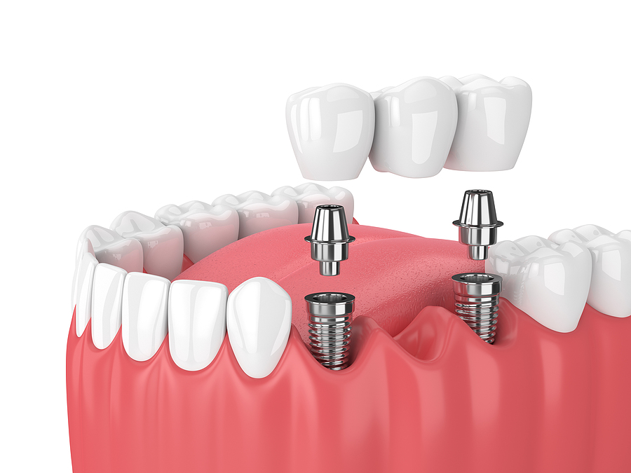 A Complete Guide to Dental Implants: Restoring Your Smile with Confidence