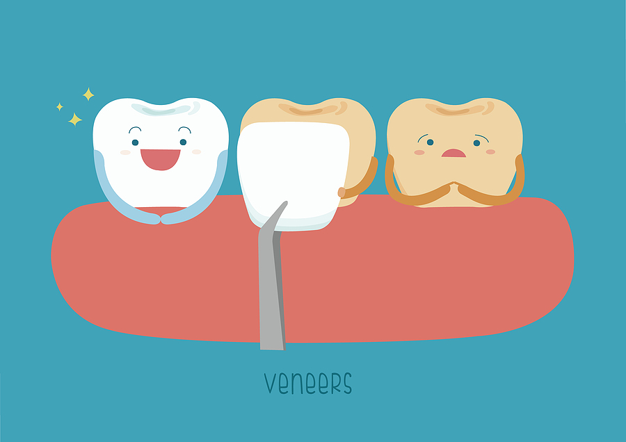Transform Your Smile with Veneers: A Comprehensive Guide