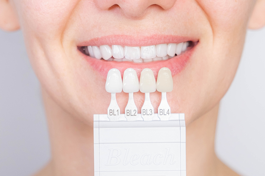 Transform Your Smile with Veneers: A Complete Guide to a Radiant Look